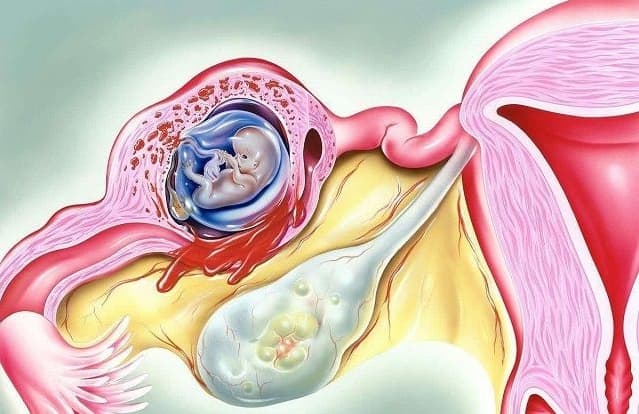孕早期出血解析：先兆流产与宫外孕的巧妙鉴别及科学建议